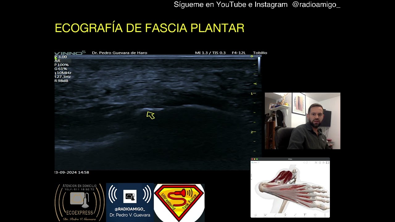 ECOGRAFIA  - REVISION DE FASCIA PLANTAR (2/3)
