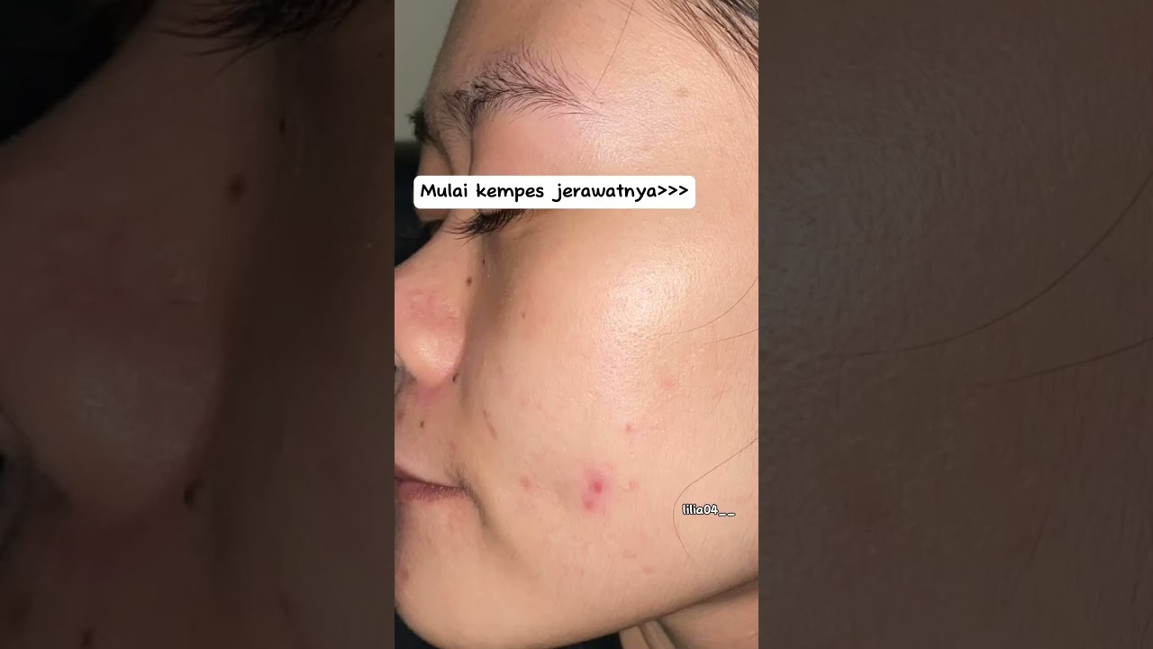 PEJUANG SEMBUH DARI JERAWAT #jerawat #pejuangjerawat #bekasjerawat #halodoc