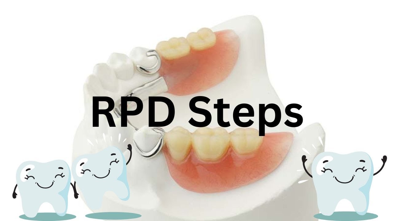 RPD step by step procedure (SIMPLIFIED)