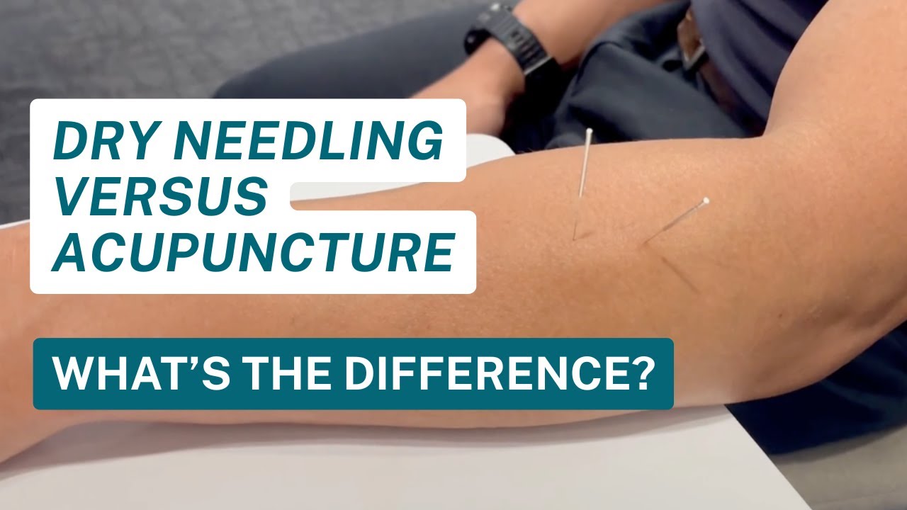 Dry Needling Versus Acupuncture: What's the Difference?