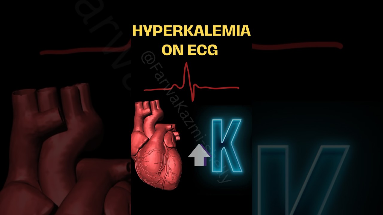 Hyperkalemia - Short case