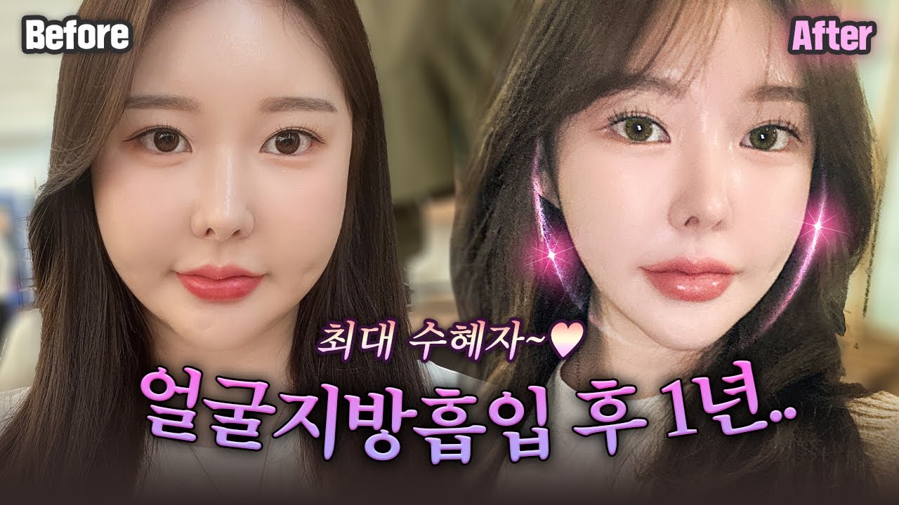 ❣️얼굴지방흡입 10개월 차｜30대 여성 2편｜안면윤곽+거상으로도 작아지지 않았던 얼굴!! 지방흡입으로는 얼마나 달라졌을지 경과 보러오세요-♥️