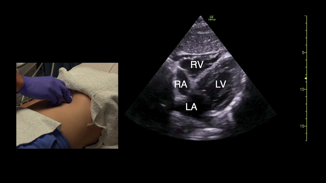 Cardiopulmonary POCUS 5 - The Subcostal Cardiac View