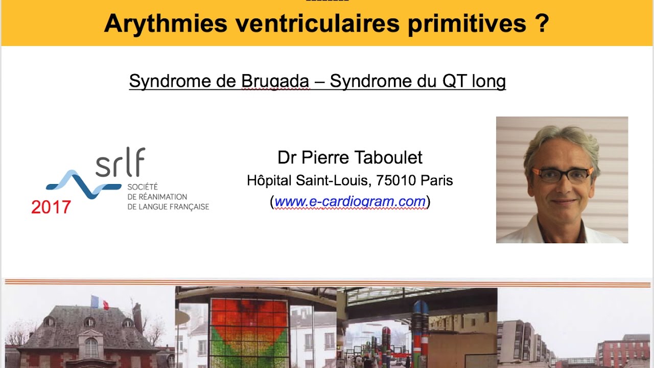 10c. Arythmie ventriculaire, Brugada, QT long