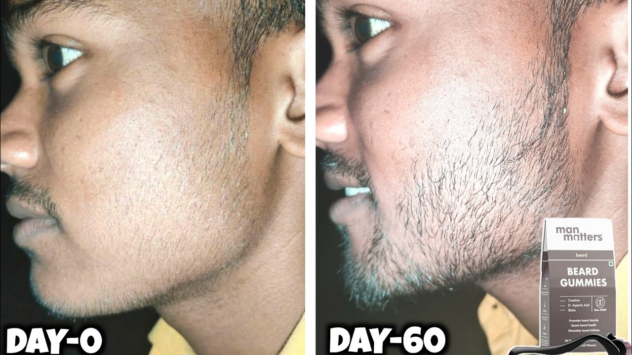 Man matters beard gummies review after use 2 months | man matters beard gummies review |beard growth
