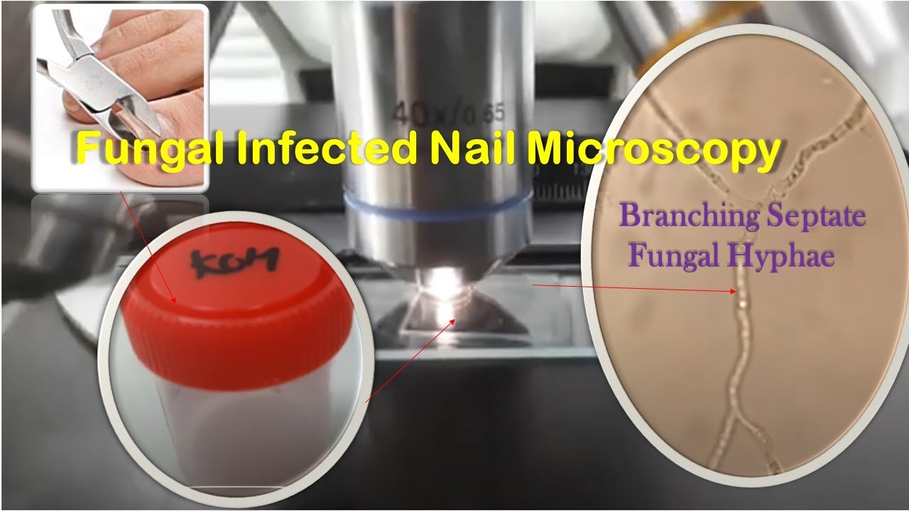Fungal hypahe in KOH Mount of Nail