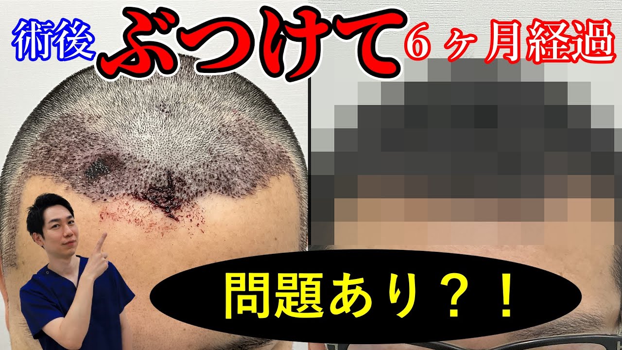 【6ヶ月経過】植毛手術後3日目にぶつけた箇所は一体どうなった？~2730株 40代患者様~