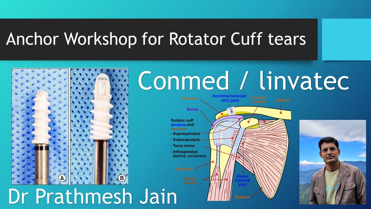 Rotator cuff anchor demonstration workshop (CONMED Linvatec)