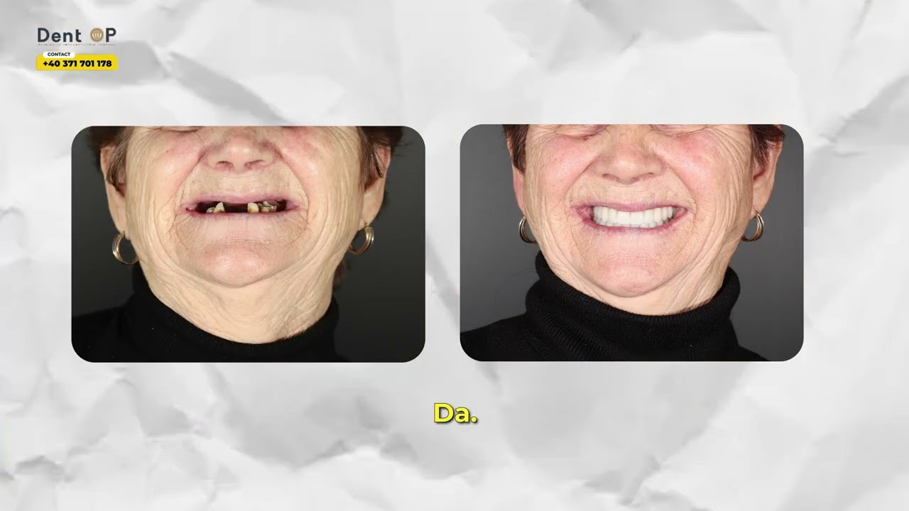 ȘI-A PUS IMPLANTURI DENTARE LA 77 DE ANI! Povestea pacientei DentOP