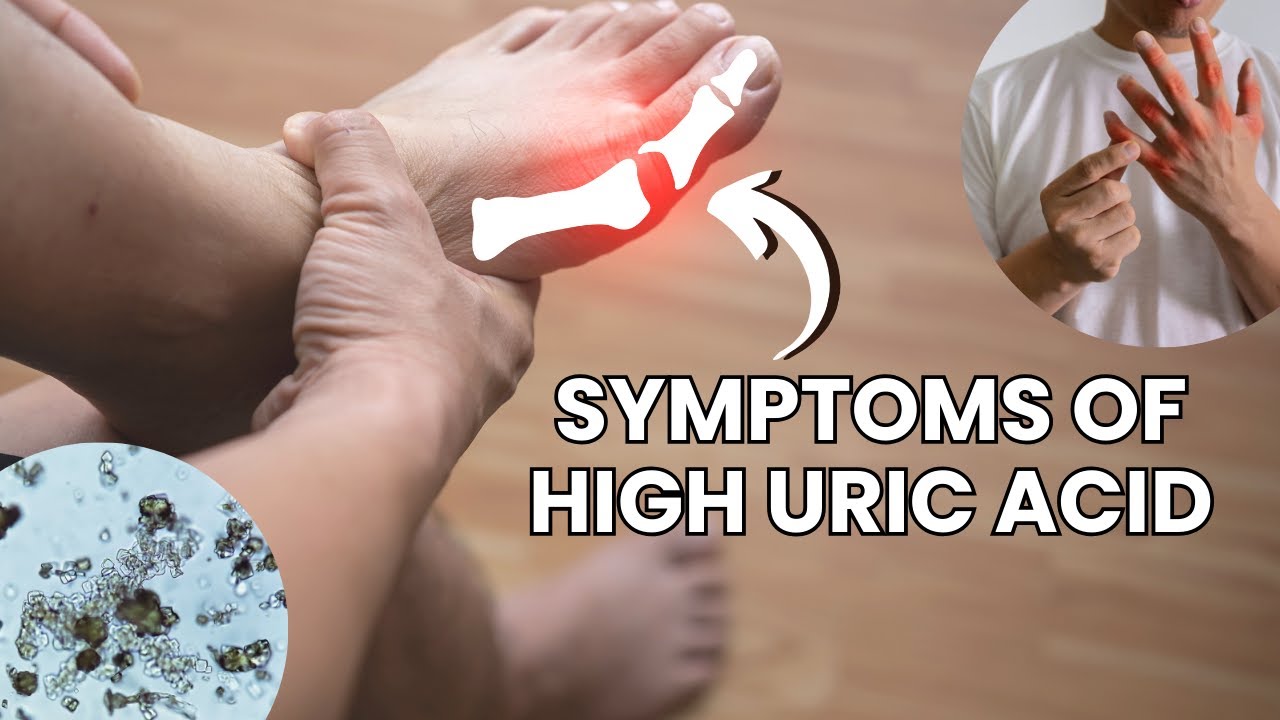 Symptoms Of High Uric Acid - Hyperuricemia Early Signs