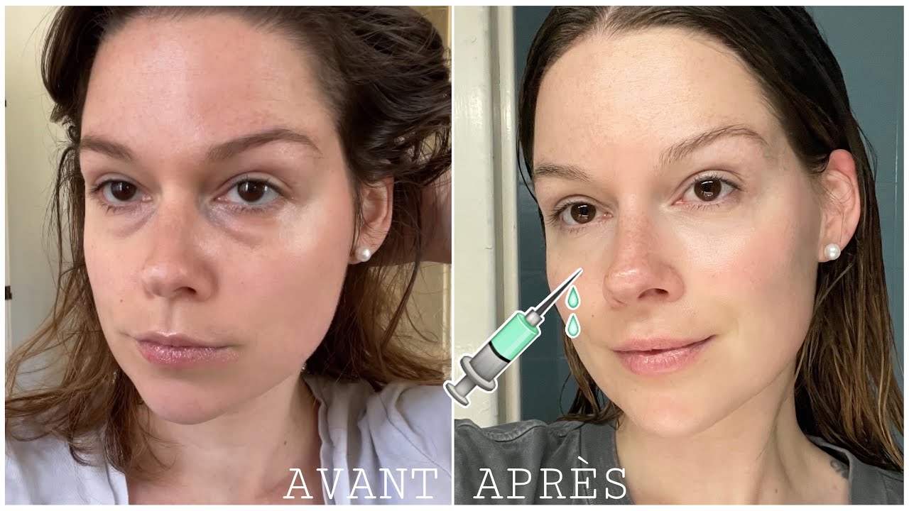 Injections dans les cernes : Mon expérience !