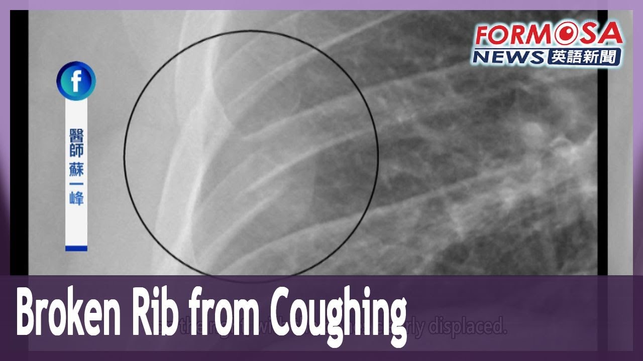 Patient with persistent cough breaks rib in a violent coughing fit｜Taiwan News