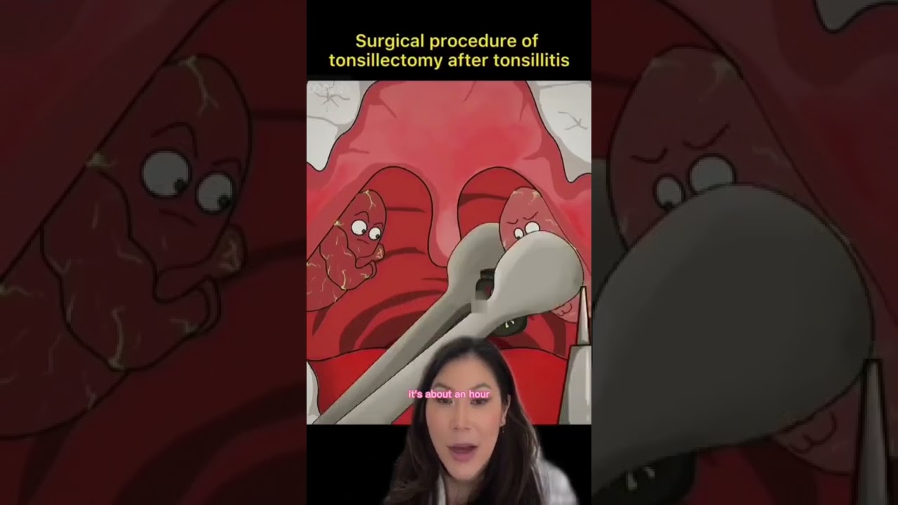 Tonsillectomy Procedure Cartoon (fast & easy) #shorts #tonsils