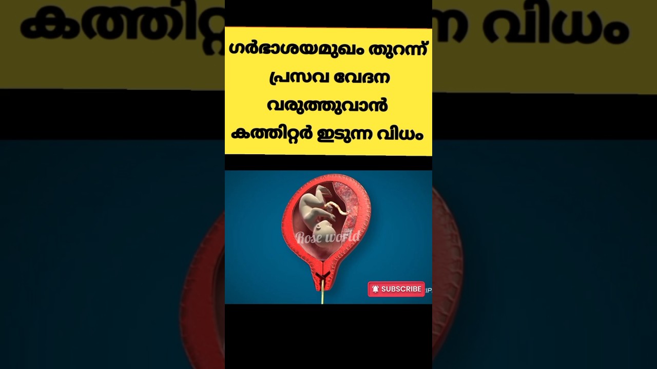 പ്രസവ വേദന വരുത്തുവാൻ  കത്തിറ്റർ ഇടുന്നത് ഇങ്ങനെ 