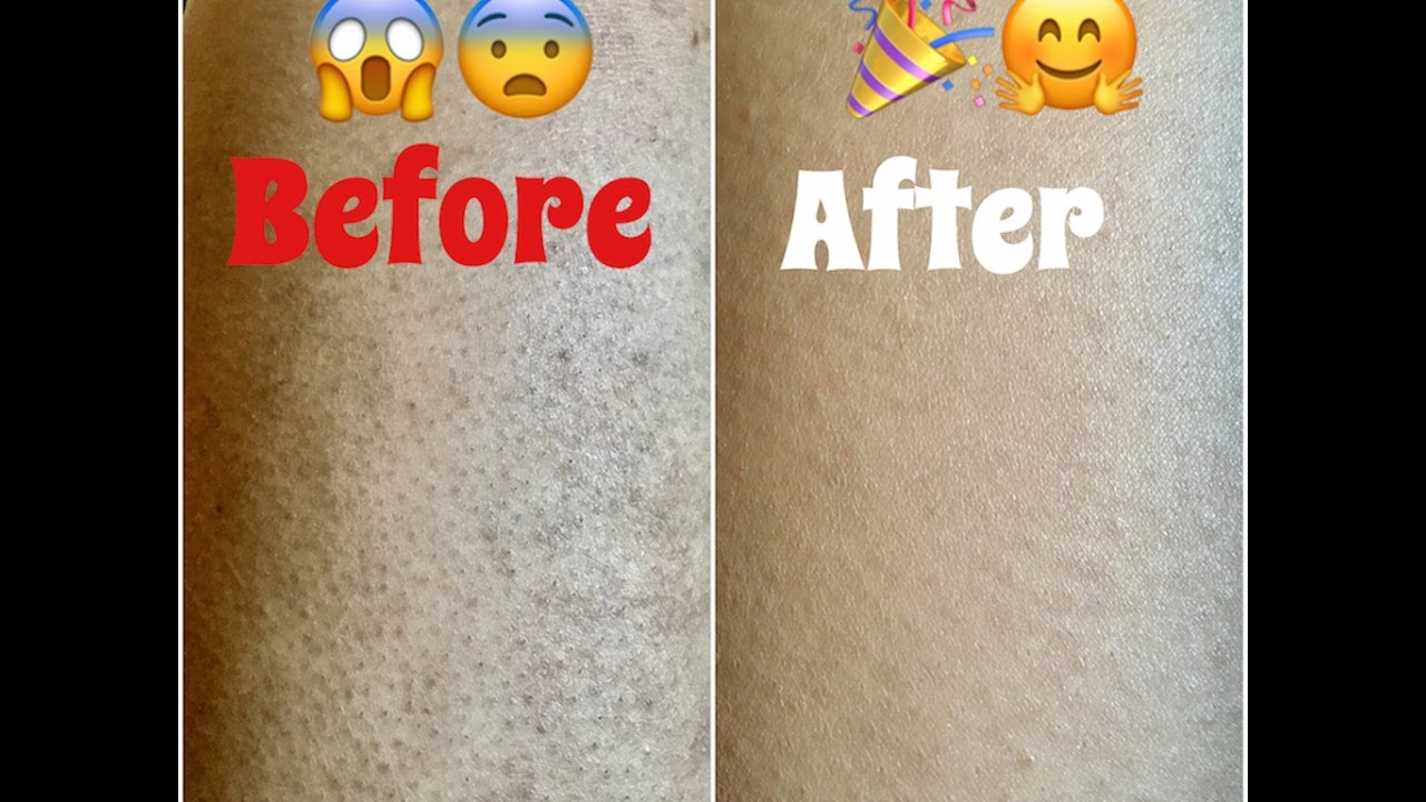 HOW TO GET RID OF OLD SCARS FAST