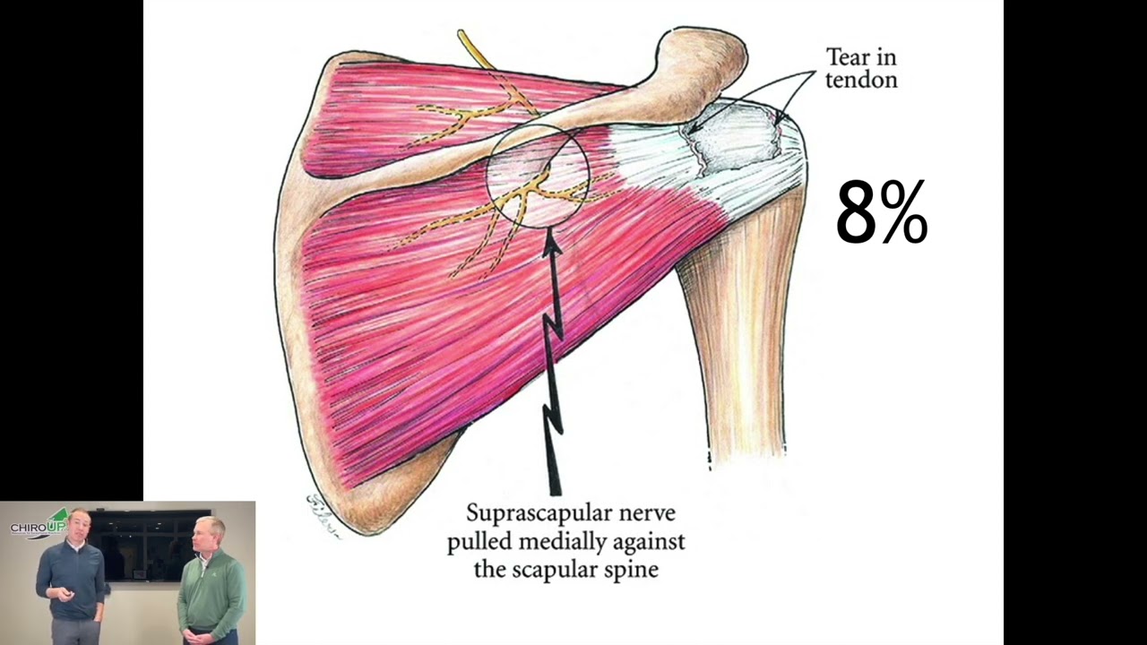 Suprascapular Neuropathy | ChiroUp