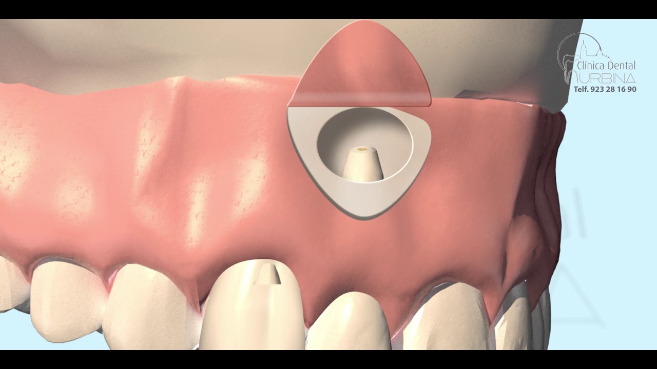 🦷Endodontics: Dental Apicoectomy🦷