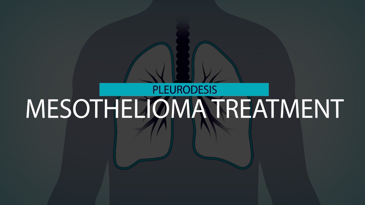 Mesothelioma Pleurodesis | Mesothelioma Hope