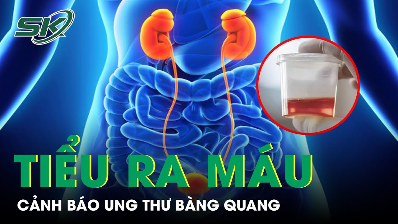 Tiểu Ra Máu, Cảnh Báo Ung Thư Bàng Quang | SKĐS