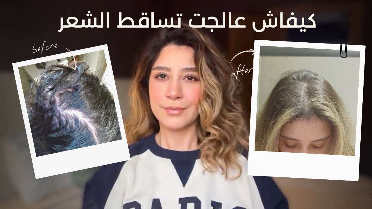 تجربتي مع المينوكسيديل | كيفاش عالجت تساقط الشعر| Hair loss journey | my experience using Minoxidil