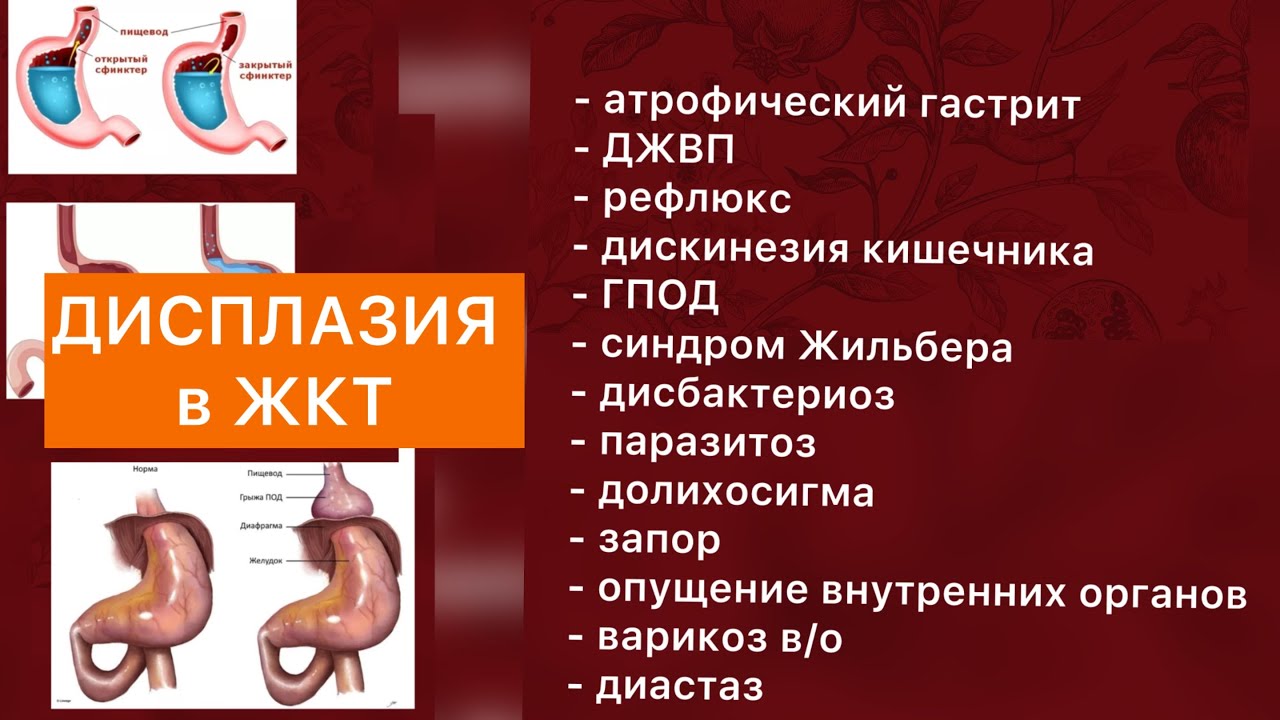 Дисплазия в ЖКТ