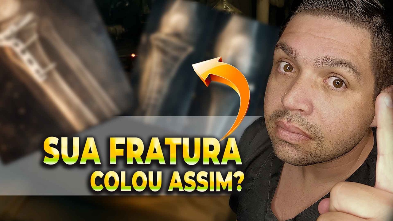 A IMPORTÂNCIA DA FISIOTERAPIA APÓS FRATURA