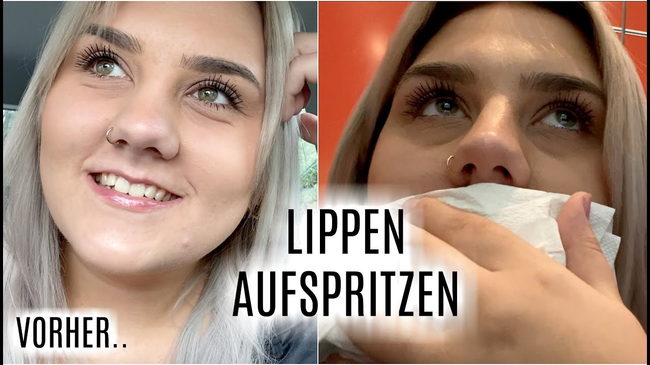 Kleine Lippen aufspritzen - Meine Erfahrung & EURE Fragen