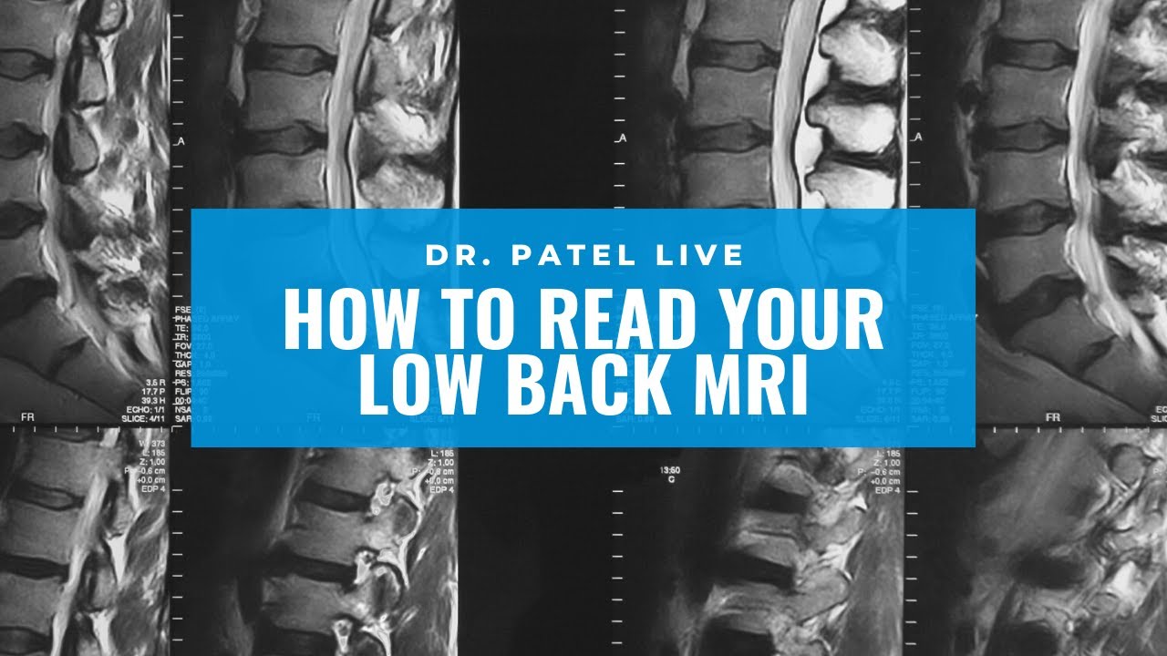 Dr. Patel LIVE: How to read your low back MRI