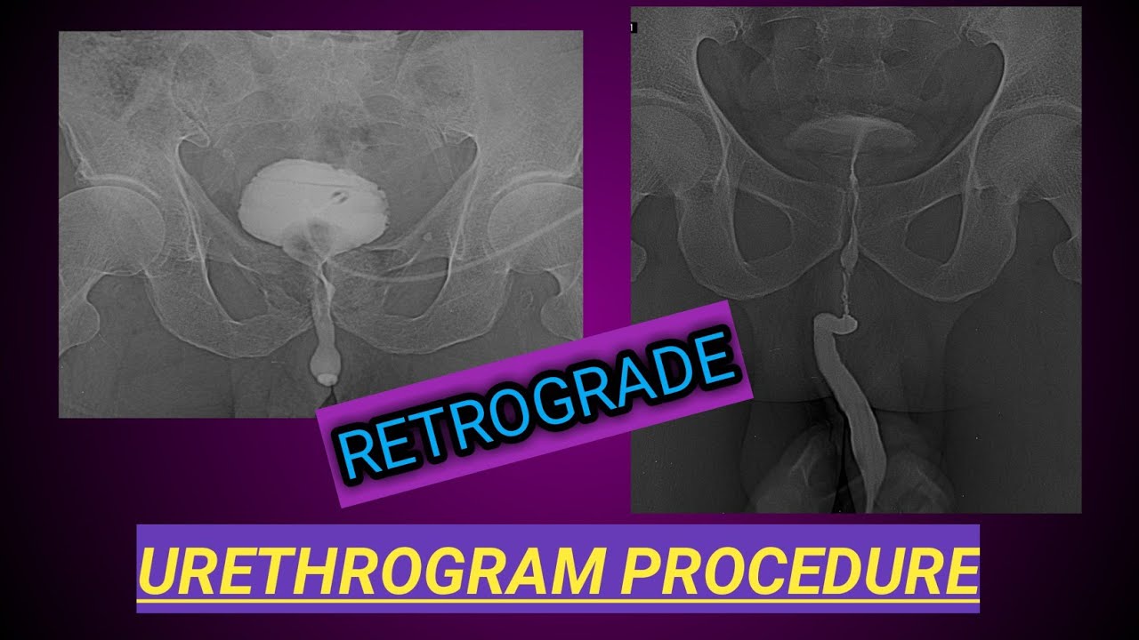 Retrograde Urethrogram Procedure | X ray Urethrogam | Urine Blockage