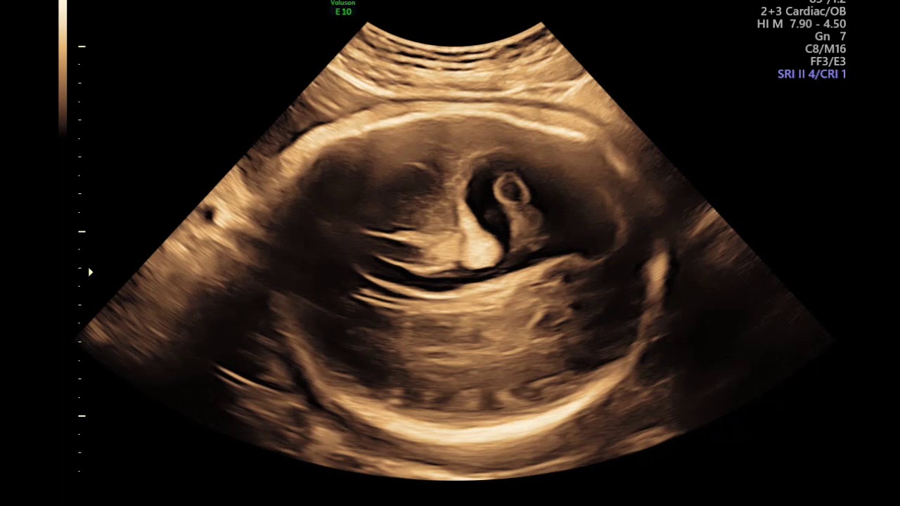FETAL INTRAVENTRICULAR HEMORRHAGE