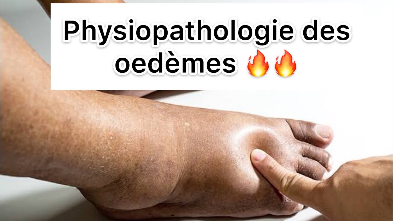📍 Physiopathologie des Oedèmes par khadidja ferdj 🔥
