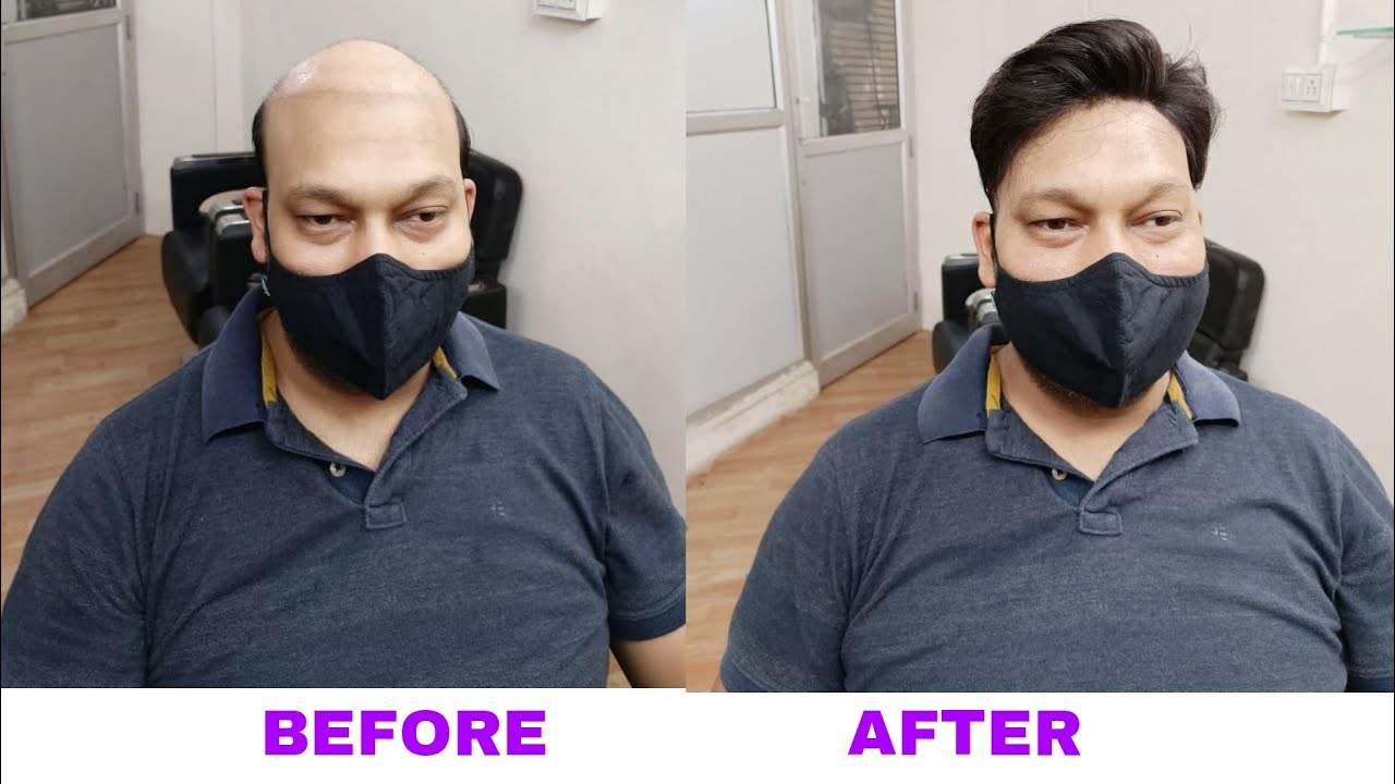Hair Patch In Lucknow |  7355087241 Hair Patch Service Near Me