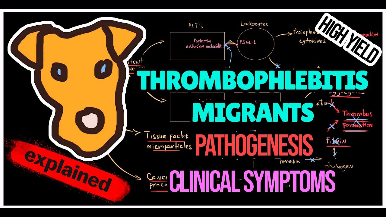 Thrombophlebitis migrants (Trousseau syndrome) Pathogenesis. Symptoms. Treatment.