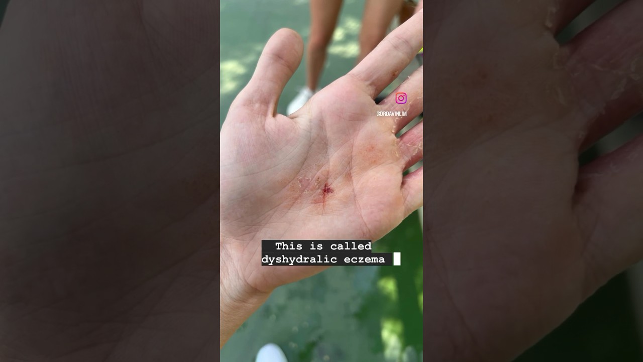 Что это за заболевание кожи?