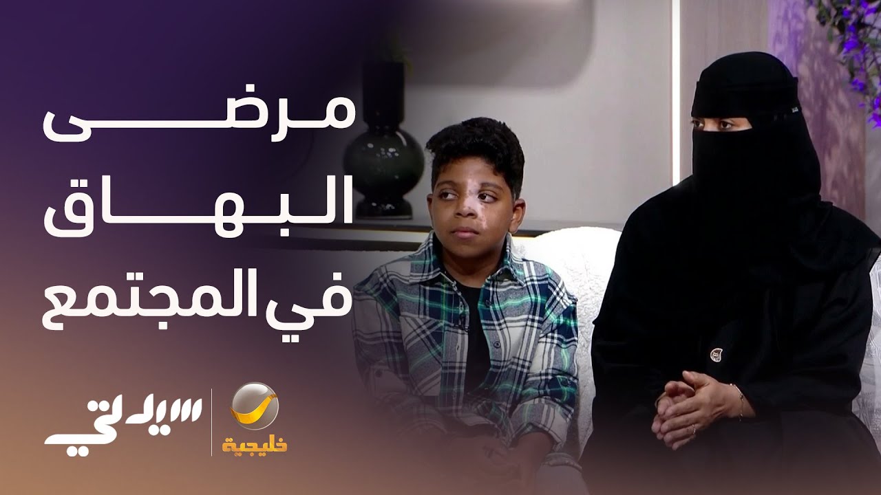 مرضى البهاق في المجتمع