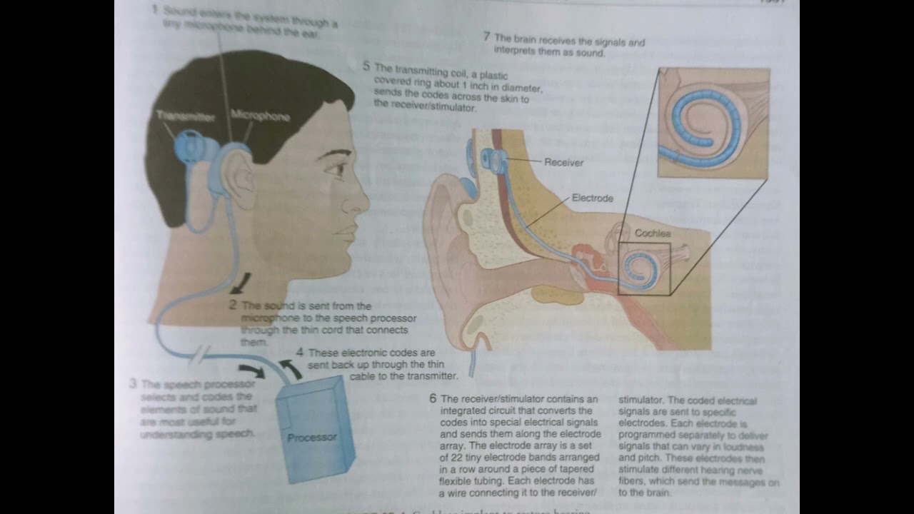 Cochlear implant 