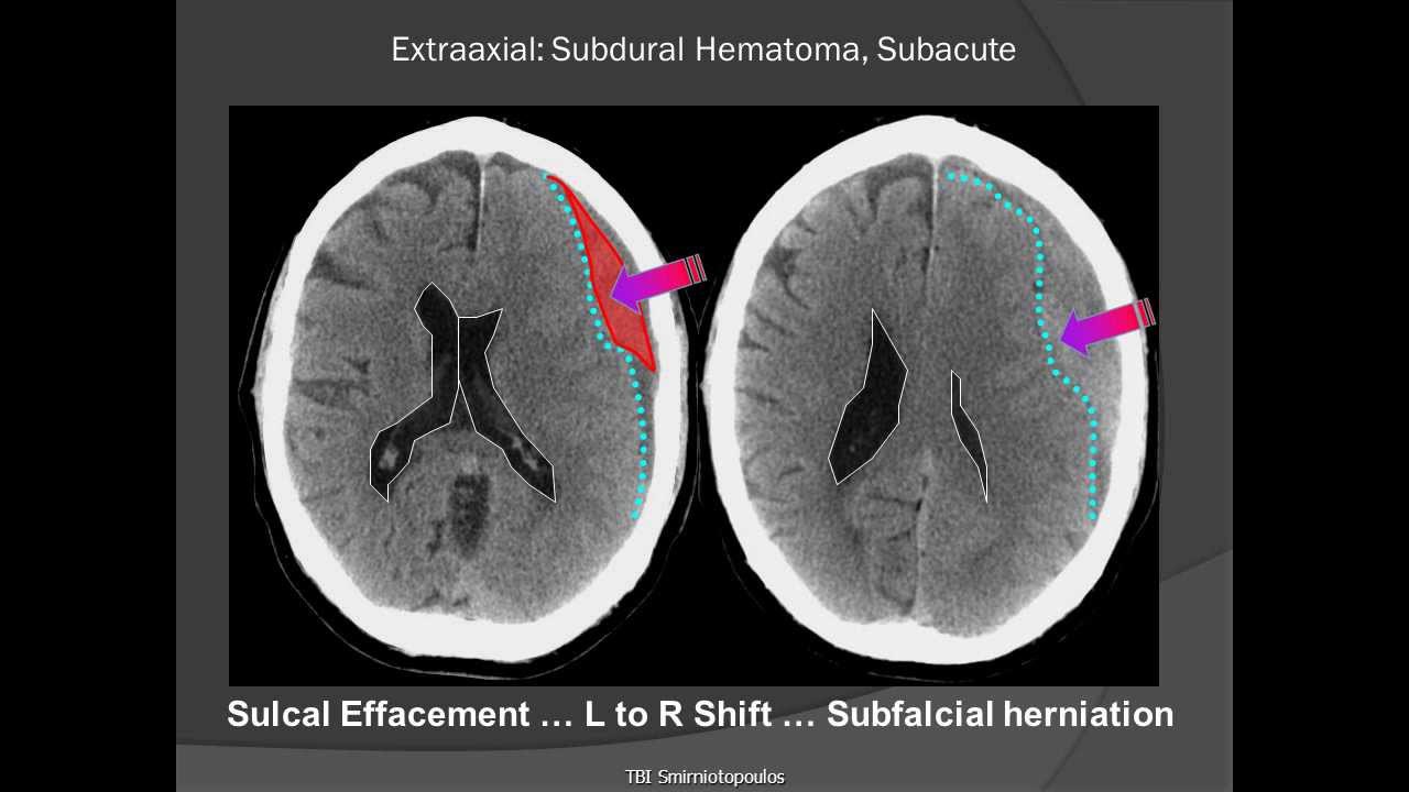 Subdural Hematoma (SDH)