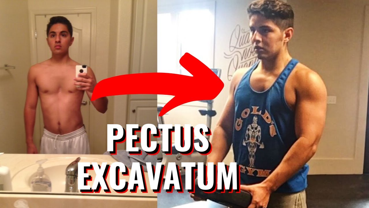 3-Month Pectus Excavatum Workout Transformation (Rich Piana Bigger By The Day Challenge)