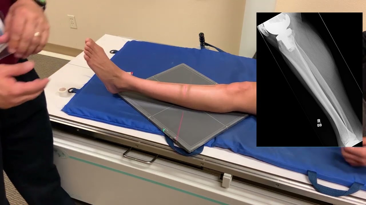 Tib Fib AP and Lateral - X Ray Positioning
