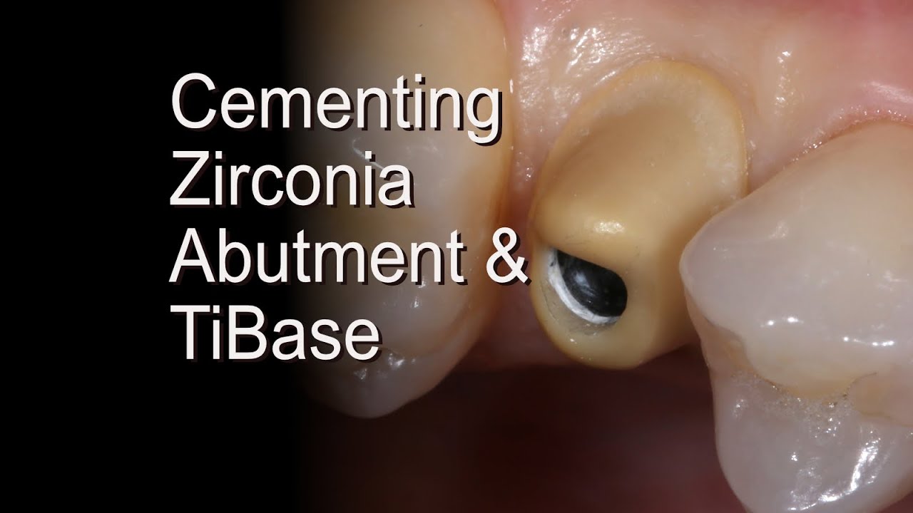 Dental Zirconia Implant Abutments