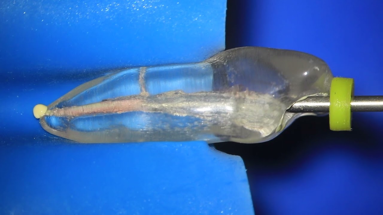 Obturação endodôntica termoplastificada.