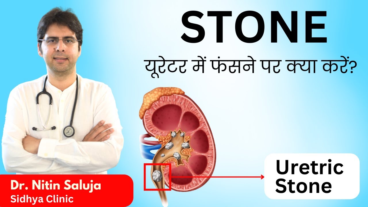 🫘 Ureter में पथरी अटक गई? I Symptoms and Treatment - Kidney Stone in Ureter II Dr. Nitin Saluja