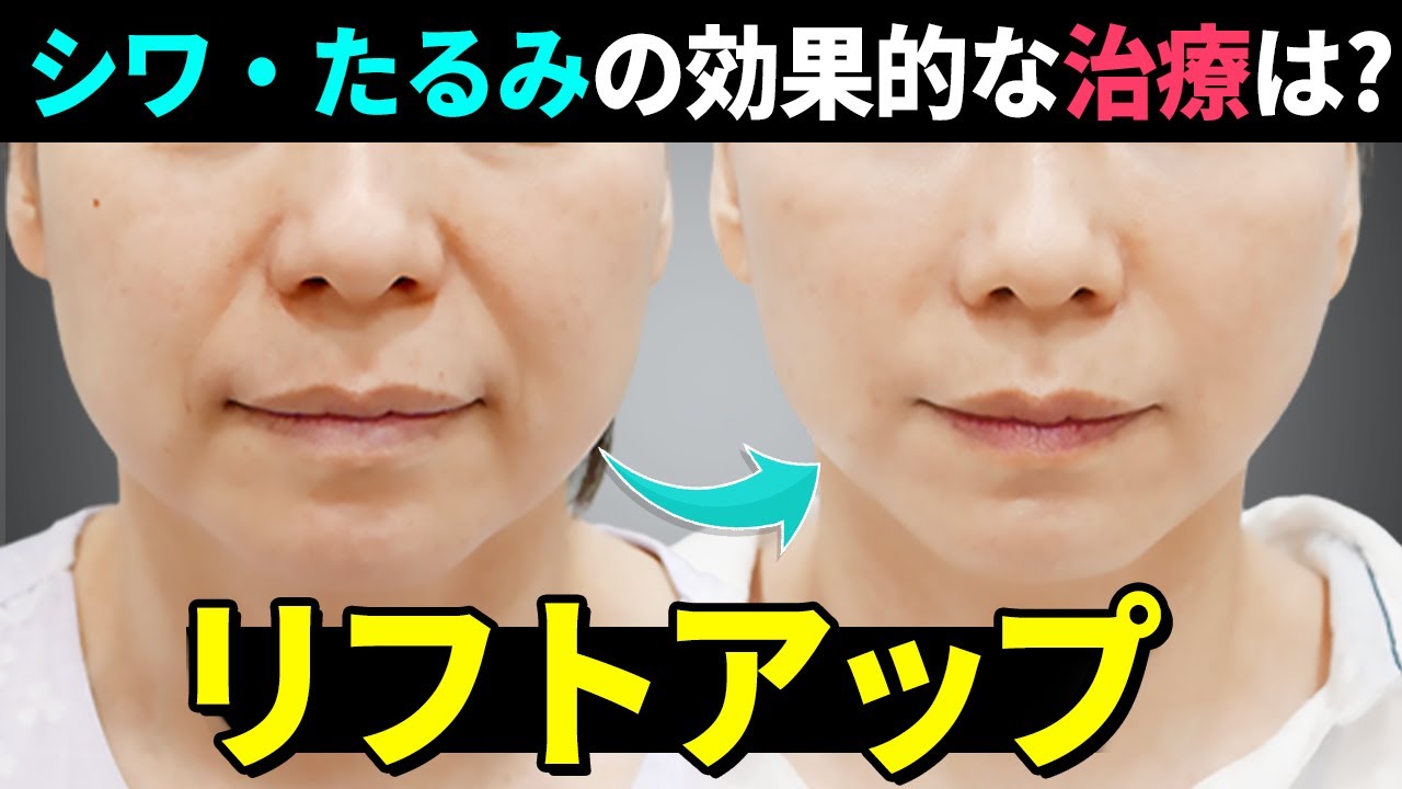 【韓国整形】 若返り治療は何から始めたらいい？フェイスリフトを徹底解説! 私にぴったりのリフティングを見つける方法！！ 【若返り・美容整形】