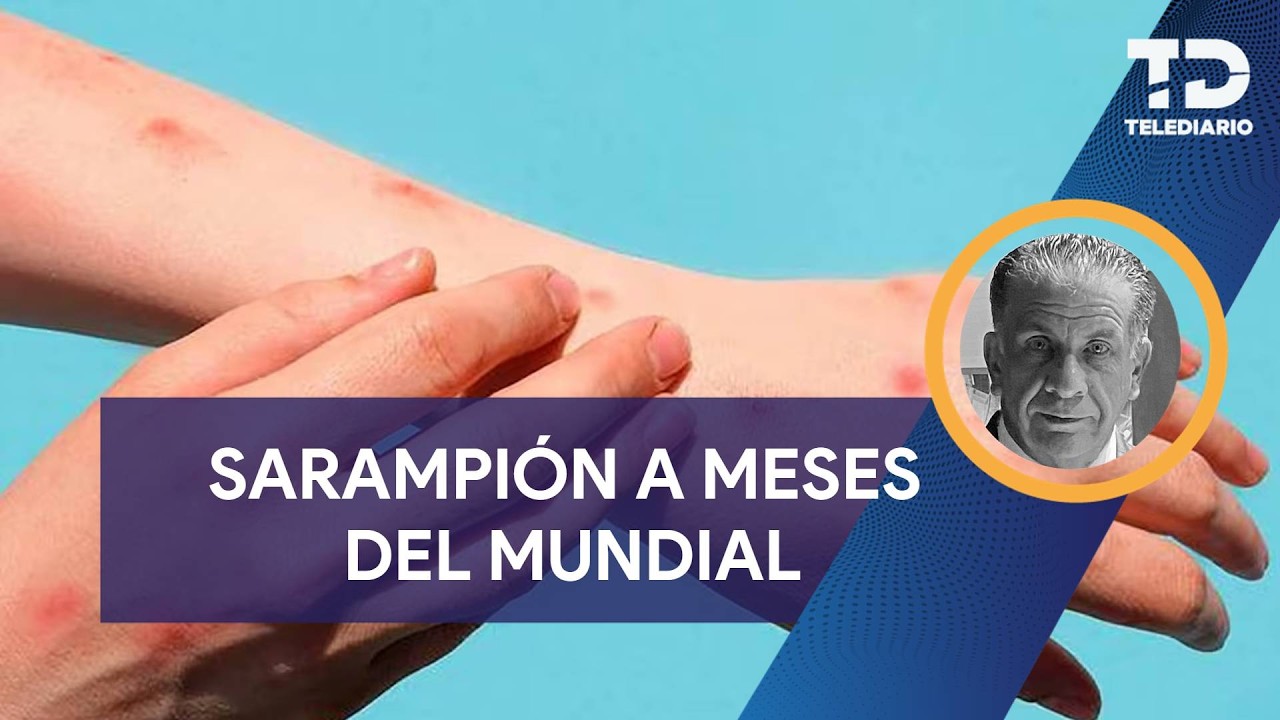 Sarampión a meses del Mundial