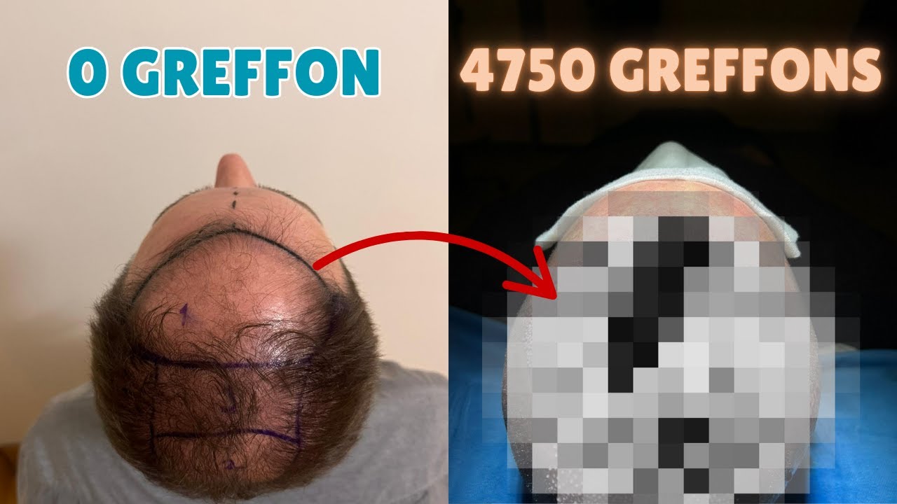 Greffe de cheveux : de l’aéroport à l’opération, mon expérience à Istanbul
