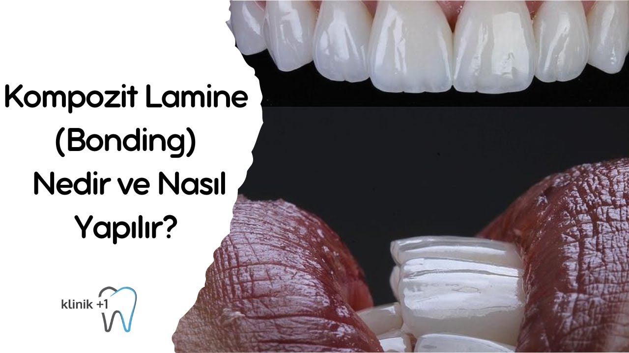 Kompozit Lamine ( Bonding) Nedir ve Nasıl Yapılır ? - Dt. Mert GEREK Estetik Diş Hekimi - Suadiye