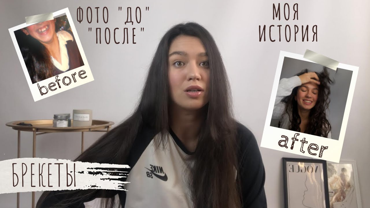 Вся правда о брекетах /Фото 