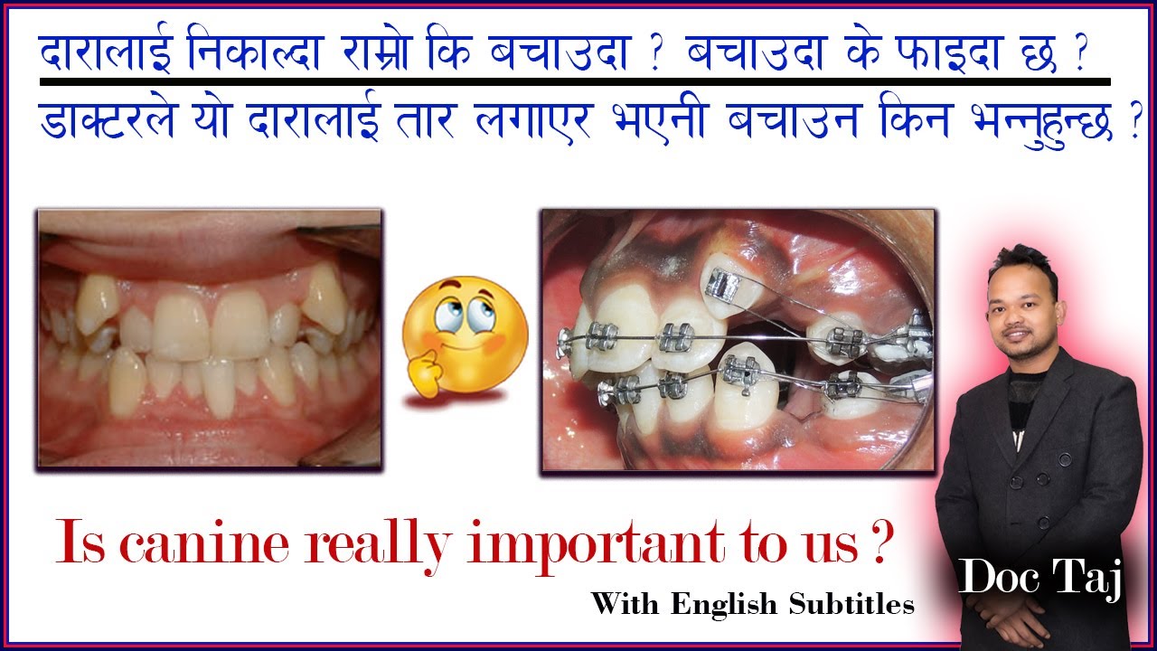 Canine importance/ Why must we save it?/कुकुर दाँत/दारालाई किन बचाउनुपर्छ?/Doc Taj/Dentist in nepal