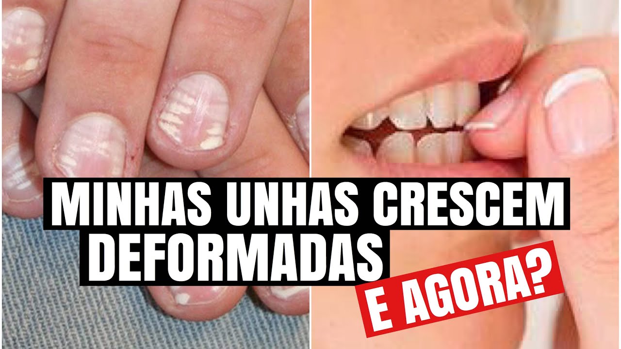 MINHAS UNHAS CRESCEM ARREBITADAS, O QUE FAZER?! #rafaresponde