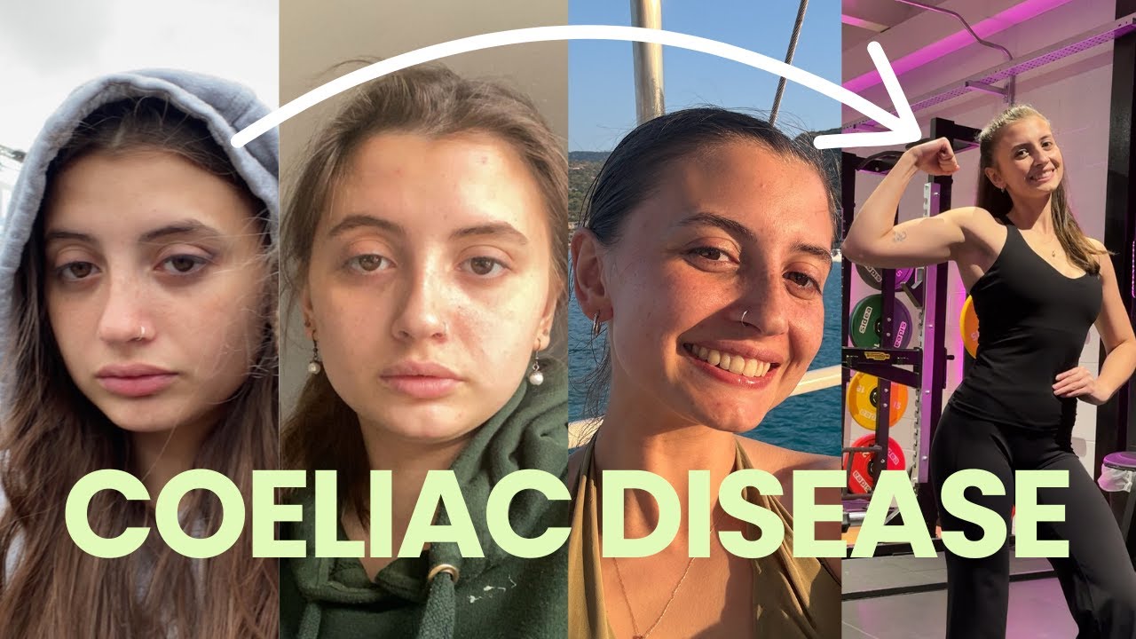 My Coeliac Disease Story + Q&A